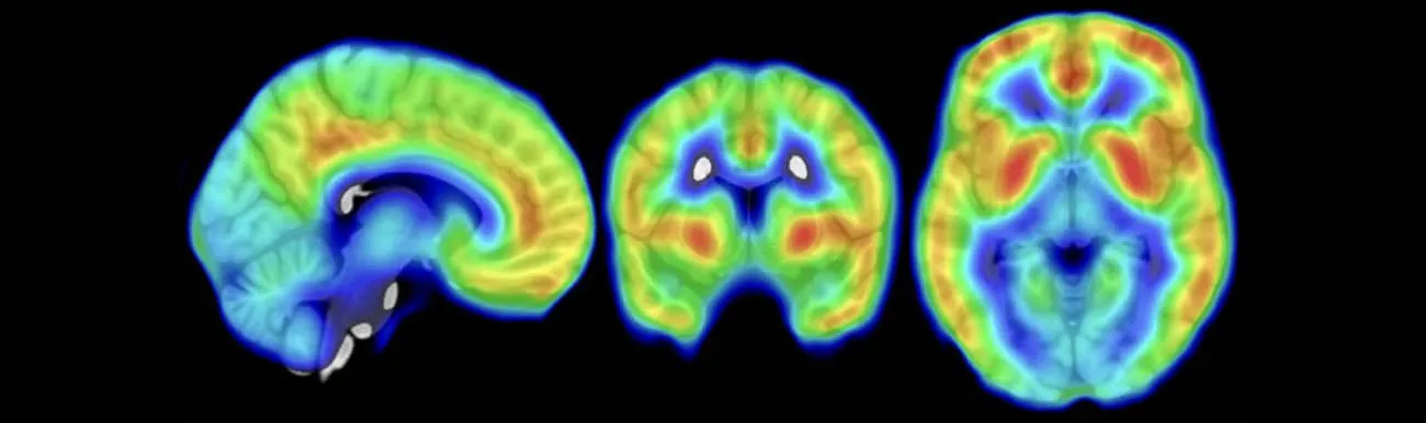 PET images of human brains with sagittal, coronal and horizontal view show abundant coloring to indicate receptor binding particularly in the cingulate gyrus and basal ganglia.