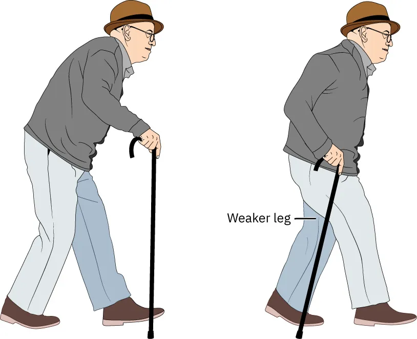 A diagram shows a patient using a cane by holding it in the hand opposite of the weaker leg.