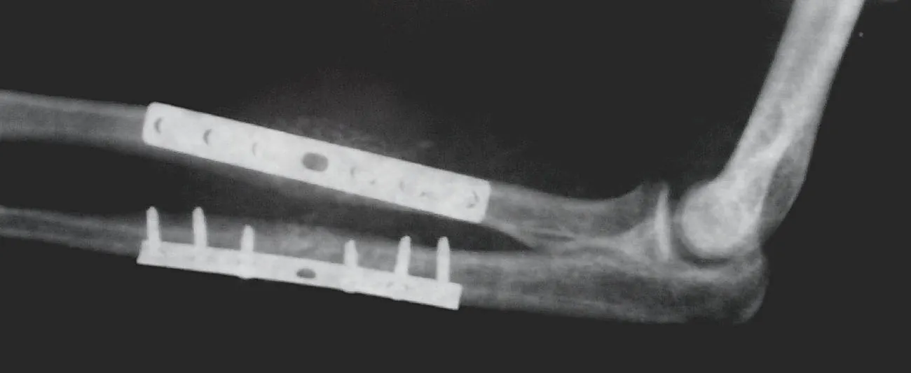 X-ray showing internal fixation of the radius and ulna