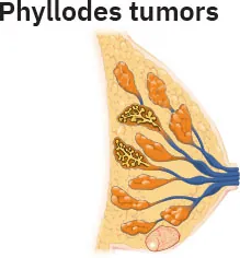 Image of inside of breast with small tumor along the bottom.