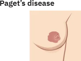 Image of breast with areola misshapen and dark.