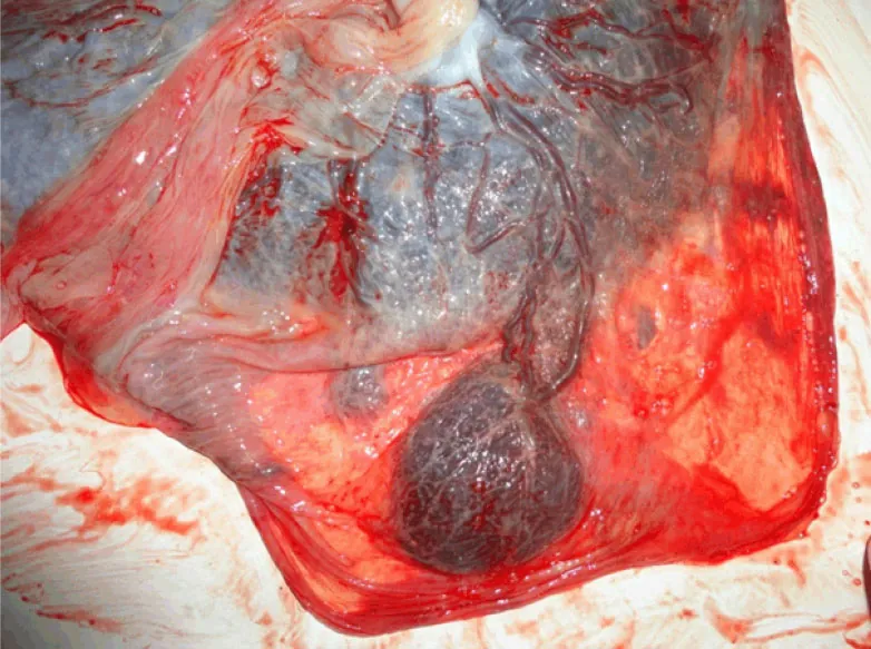 Image of placenta with succenturiate lobe.