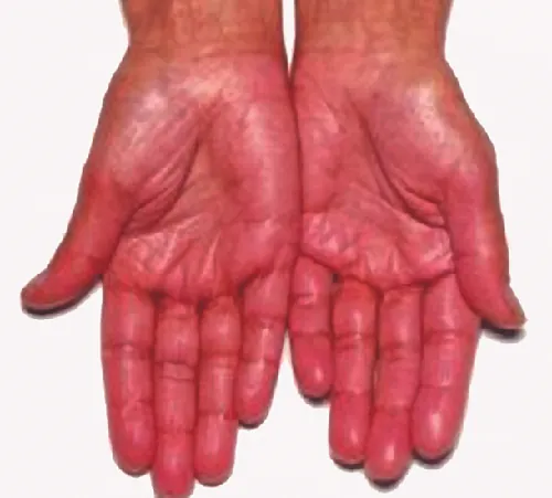 Two hands, palm up are shown. They appear to be redder than is normal.