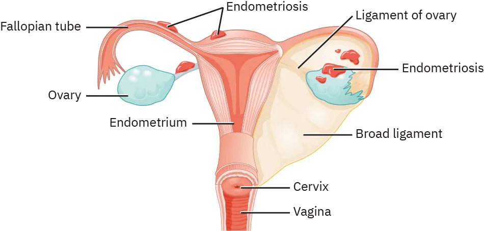 A color and labeled diagram of the female organs showing endometriosis along the fallopian tubes and ovaries. The endometriosis is shown as growths along the fallopian tubes and ovaries.