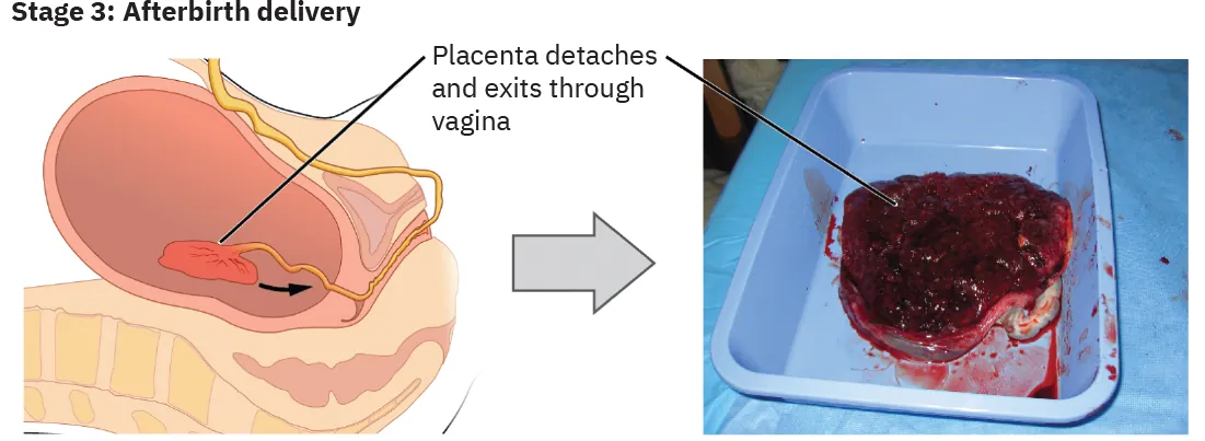 Illustration of Stage 3: Afterbirth delivery. Placenta detaches and exits through the vagina. Photo of placenta after delivery in a tub.