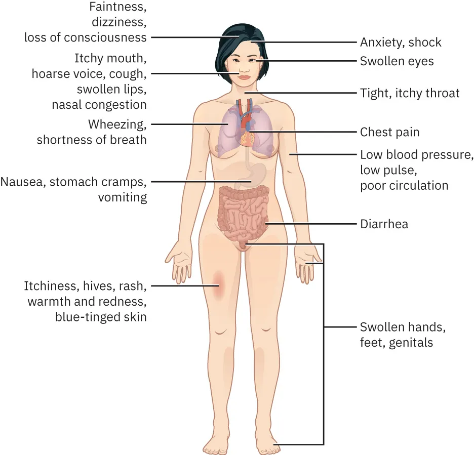 Diagram of hypovolemic shock signs: anxious, irritable, dizziness, confusion, syncope, dilated pupils, tachycardia, tachypnea, prolonged capillary refill, cyanosis of nailbeds, cold skin, clammy, pale skin, diarrhea, hives, swollen hands, feet, genitals, etc...
