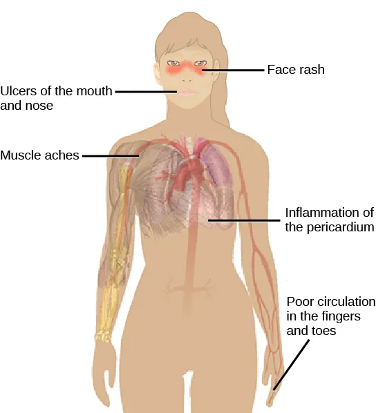 Illustration shows the symptoms of lupus, which include a distinctive face rash across the bridge of the nose and the cheeks, ulcers in the mouth and nose, muscle aches, inflammation of the pericardium, muscle aches and poor circulation in the fingers and toes.