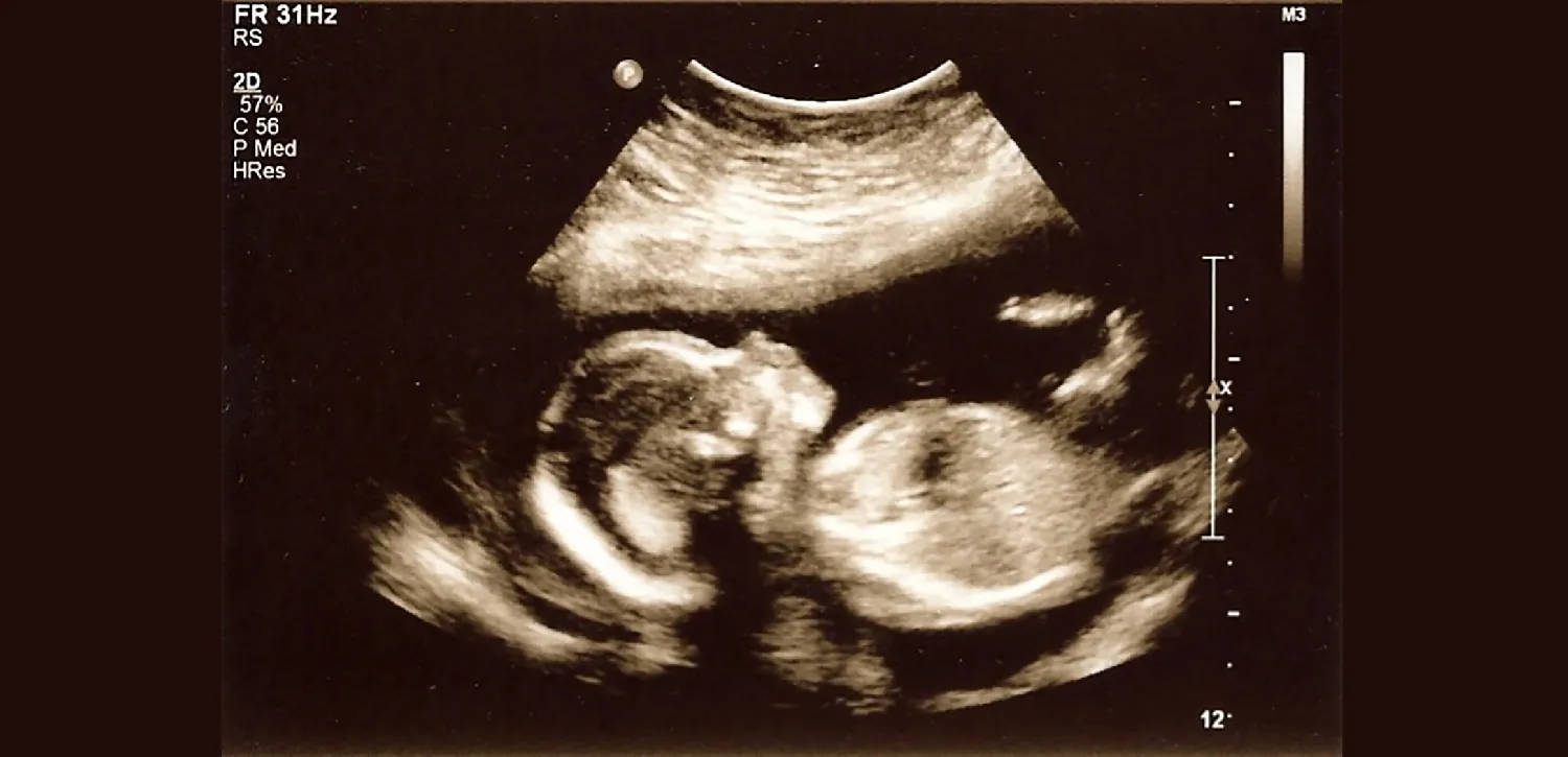 Ultrasound image of fetus in utero.