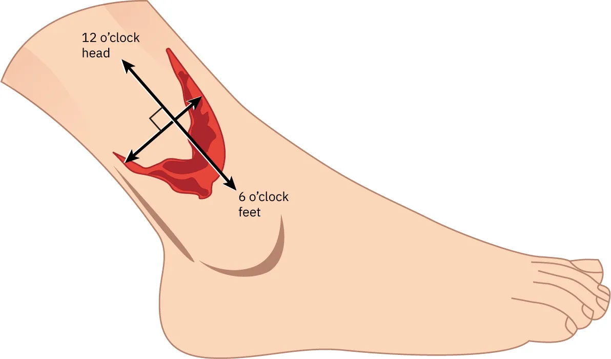 An illustration of a foot and ankle showing a deep arterial wound on the side. An arrow from top to bottom indicates the length, with the head labeled at 12 o’clock and the feet labeled at 6 o’clock. Another arrow indicates the width