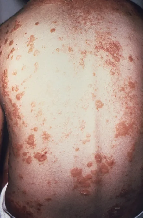 A photograph shows the back of a patient who has been diagnosed with psoriasis. The entire back is covered in clusters of raised, red, scaly patches.
