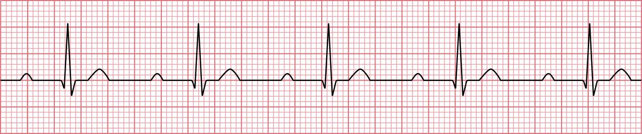 Sinus rhythm showing NSR with first AV block.