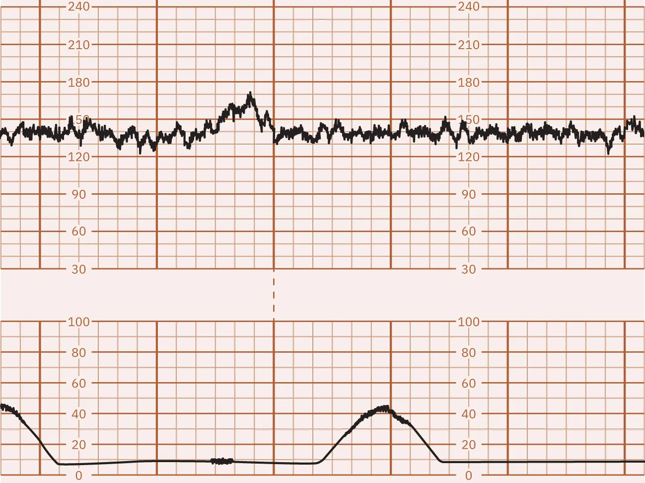 Fetal heart rate reading indicating acceleration.