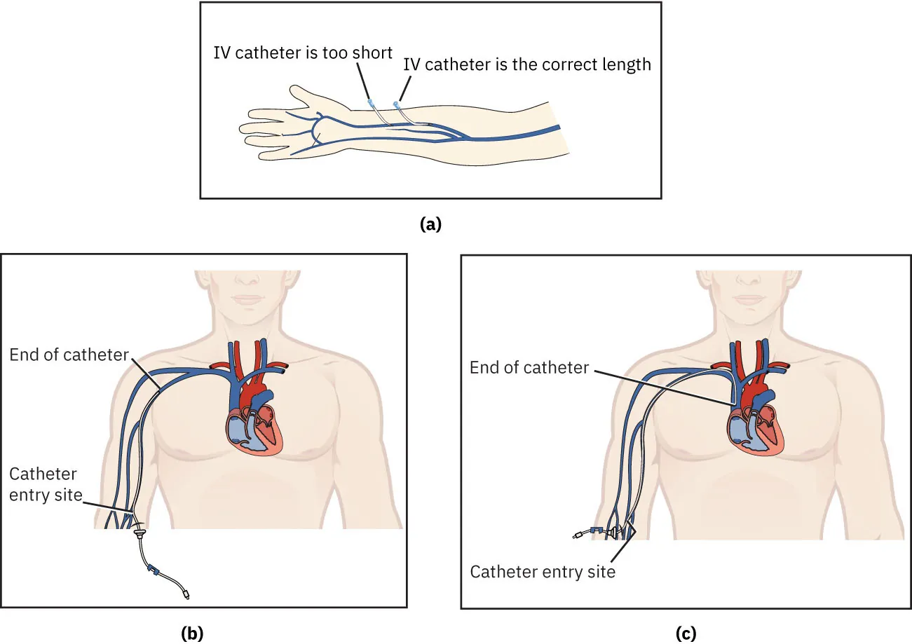 A three-part diagram shows an IV catheter. Image (a) shows an arm with veins and an IV catheter. The label reads “IV catheter is too short” and “IV catheter is the correct length.” Image (b) shows a head and torso with the heart and catheter shown. The labels include “end of catheter” and “catheter entry site.” Image (c) shows a head and torso with the heart and catheter shown. The labels include “end of catheter” (shown in the heart) and “catheter entry site.”