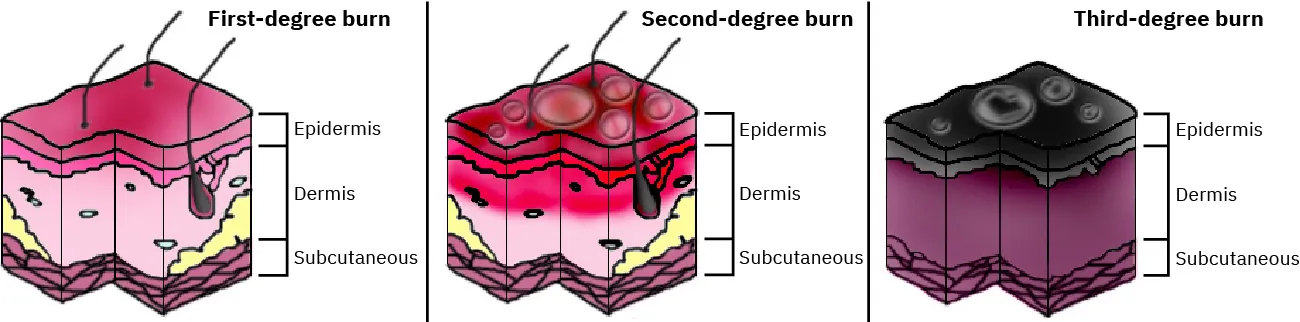 Diagram showing the three degrees of burns.