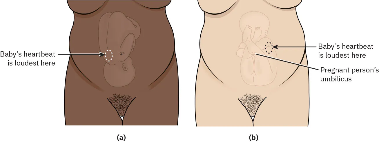 Diagram showing (a) baby's heartbeat loudest in the lower abdomen, (b) baby's heartbeat loudest above the umbilicus.