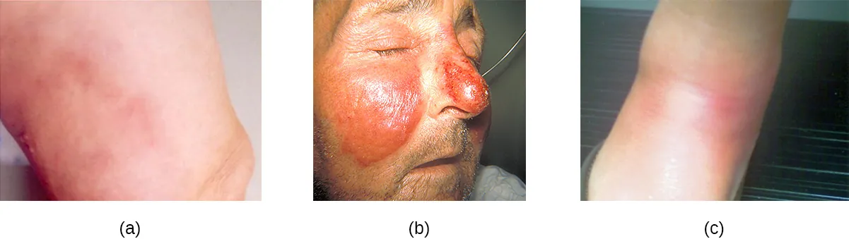 a) a red rash. B) swollen, red regions on the cheeks and nose. C) red lumps on the skin.