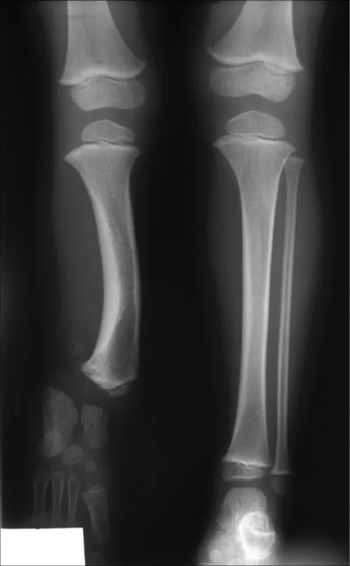 The image is an X-ray showing the lower legs and feet of a child, presenting a clear view of the tibia, fibula, knee, and ankle joints, as well as the bones of the feet.