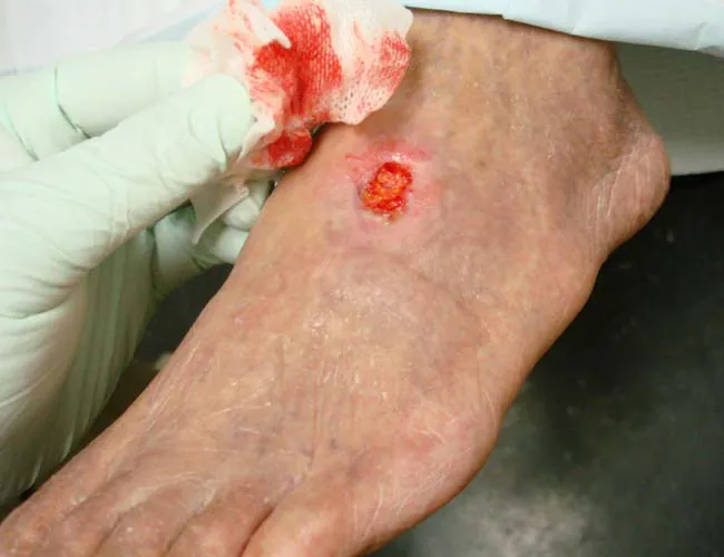 Photograph of arterial ulcer in foot.
