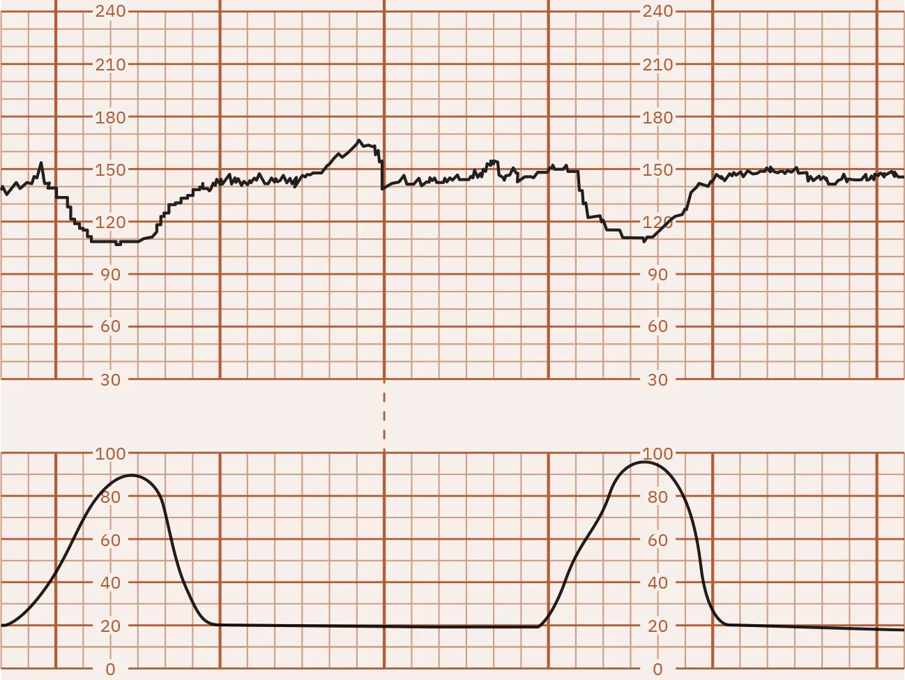 Fetal heart rate reading indicating early decelerations.