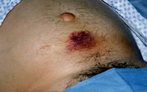 A close-up view of a patient's abdomen revealing a distinct periumbilical ecchymosis, known as Cullen's sign. This purplish discoloration, located to the right of the umbilicus, is indicative of retroperitoneal bleeding. Body hair is also visible.