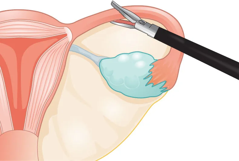 Image of instrument cutting the fallopian tube between the ovaries and the uterus.