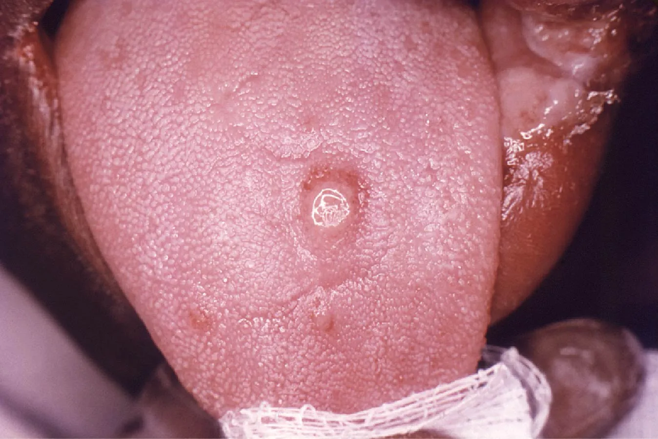 Image of a round sore on a tongue.