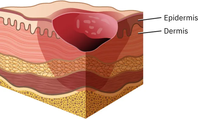 Stage II pressure injury and partial loss of skin.