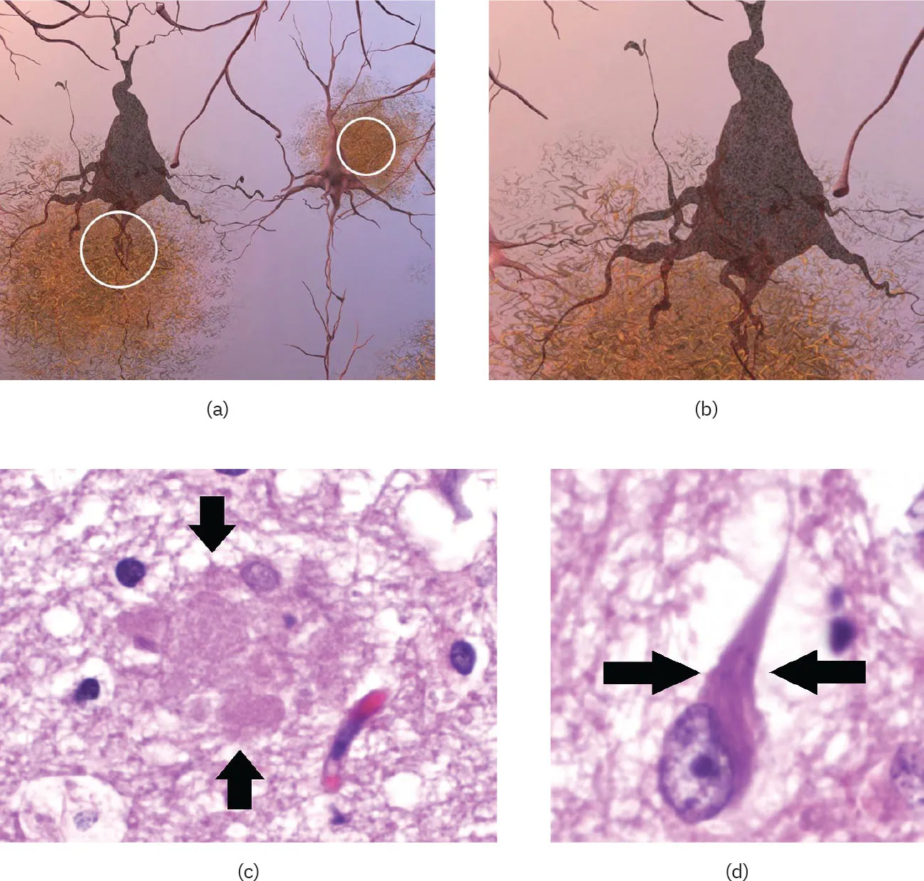(a) An image shows plaques between neurons. (b) An image shows twisted strands of protein, neurofibrillary tangles. (c) A micrograph shows plaques. (d) A micrograph shows tangles.