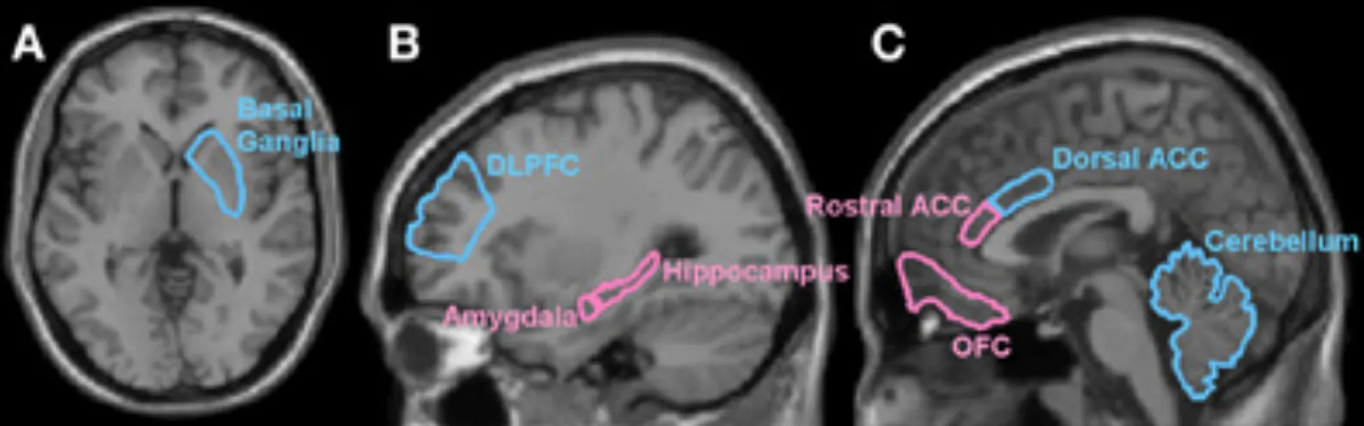 MRIs of adult brain highlighting regions associated with emotion and motivation (amygdala, hippocampus, rostral ACC, OFC) and higher order functions such as working memory and attention (basal ganglia, DLPFC, dorsal ACC, cerebellum). These are brain regions where functional and structural changes are prominent as a result of mistreatment.
