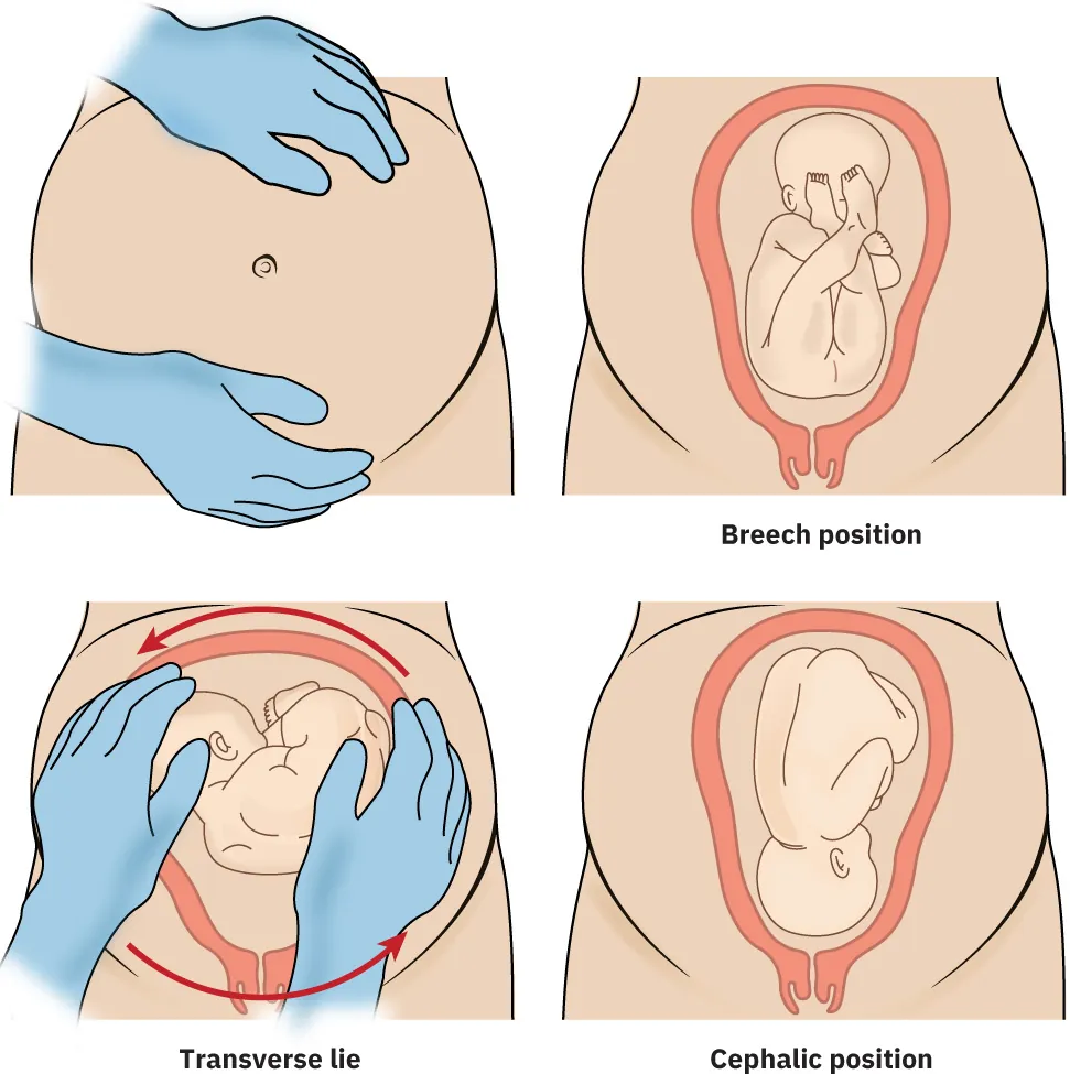 External Cephalic Version (ECV): hands on pregnant abdomen, breech position where fetus is bottom toward cervix, transverse lie where fetus is across, and head-down position where head of fetus is at cervix.