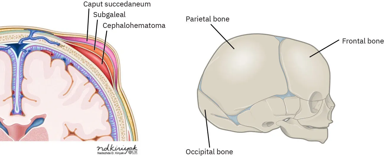 A medical diagram showing a side view of a newborn's head with labels identifying swelling conditions like caput succedaneum and cephalohematoma, alongside a side view of a newborn's skull labeling the parietal, occipital, and frontal bones.
