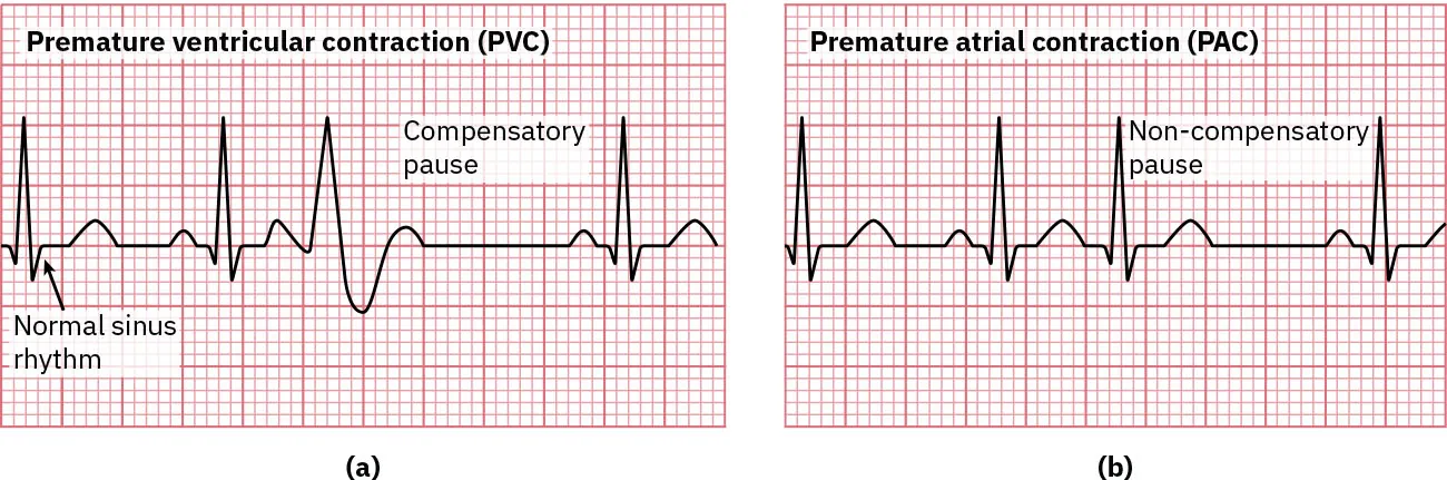 (a) Sinus rhythm showing Premature ventricular contraction (PVC), labeling Normal sinus rhythm and Compensatory pause and (b) non-compensatory pause.