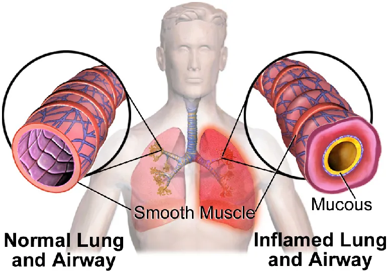 A cross-section of a normal lung and airway on the left and an inflamed lung and airway on the right. In the normal lung, the airway is a wide open tube with no inflammation. In the inflamed lung, the airway is narrowed due to mucous and the airway appears swollen.