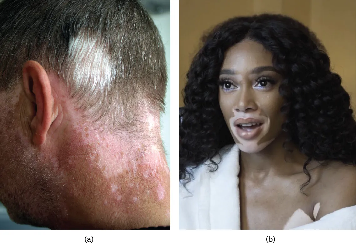 (a) This photo shows the back of a man’s neck. There is a large, discolored patch of skin at the base of his hairline. The discolored area extends over the ears onto the cheeks, toward the front of the face. The man’s head and facial hair are mostly gray, but white patches of hair are seen above the discolored skin. (b) A photograph of the model Winnie Harlow, who has patches of unpigmented skin around her mouth and face. 