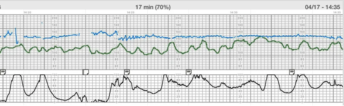 Image shows consistent uterine contractions and a rising uterine baseline.