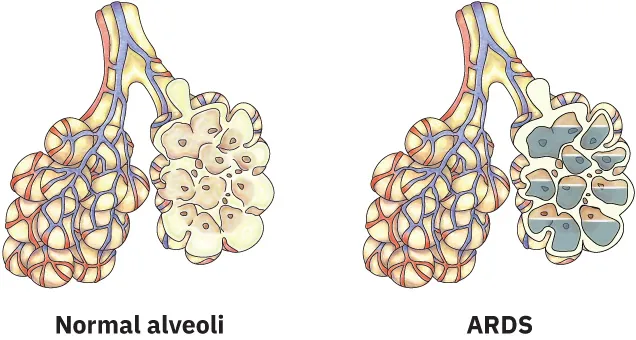 Diagram showing normal alveoli and ARDS