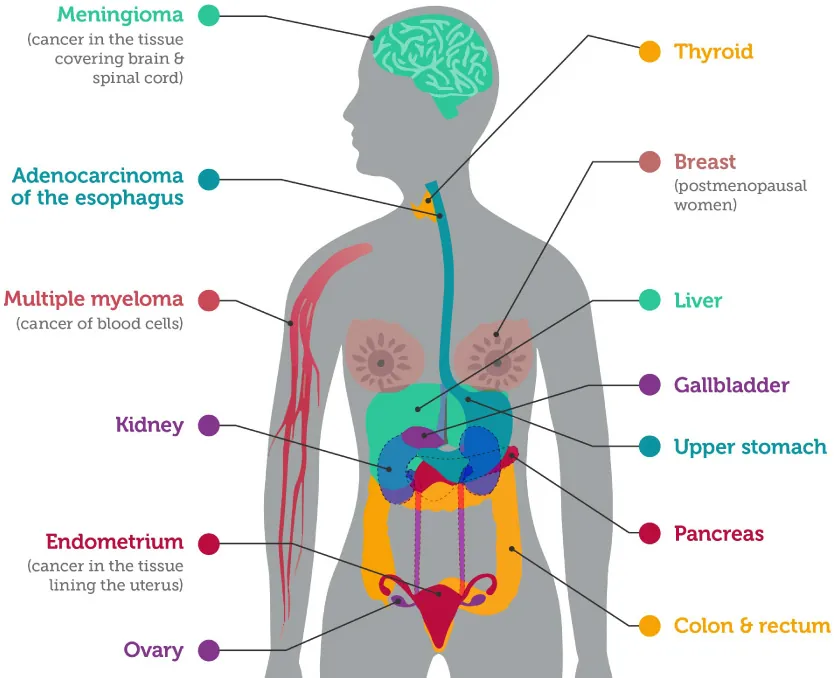 Diagram showing groups of cells: Normal, Hyperplasia, Mild dysplasia, Carcinoma in situ (severe dysplasia), Cancer (invasive) Diagram of body labeling Meningioma (cancer in the tissue covering brain & spinal cord), Adenocarcinoma of the esophagus, Multiple myeloma (cancer of blood cells), Kidney, Endometrium (cancer in the tissue lining of the uterus), Overy, Thyroid, Breast (postmenopausal women), Liver, Gallbladder, Upper stomach, Pancreas, Colon & rectum