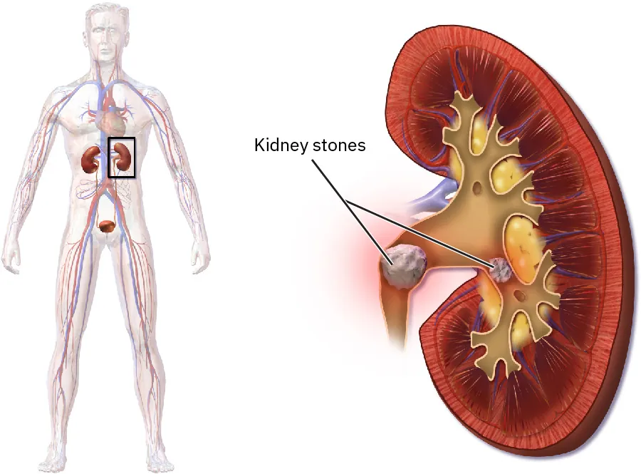 An anatomical illustration showing the human urinary system on the left and a detailed cross-section of a kidney with kidney stones on the right. The kidney cross-section highlights the location of kidney stones within the kidney, emphasizing their appearance and positioning.