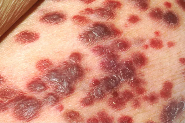 The image shows a close-up of a skin condition characterized by multiple dark red to purplish lesions, some of which appear raised. The lesions are irregular in shape and size, scattered across the skin. This appearance is suggestive of Kaposi's sarcoma, a type of cancer that often affects the skin and is associated with HIV/AIDS.