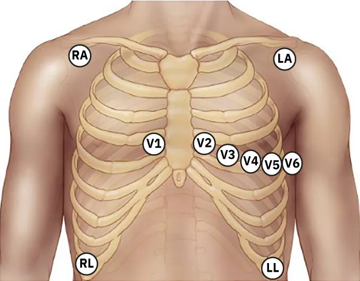 An image showing the ECG electrode placement.