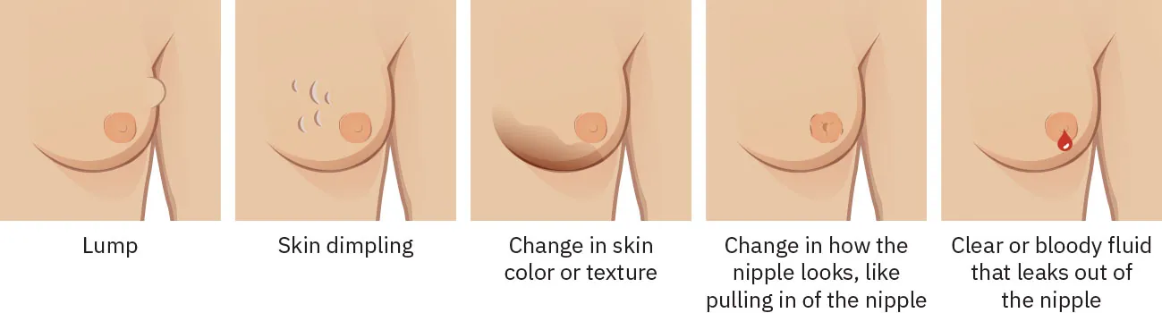 A series of color illustrations of breasts showing changes that may indicate the development of breast cancer. There are five different illustrations. These include: lump, skin dimpling, change in skin color or texture, change in how the nipple looks, like pulling in of the nipple, and clear or bloody fluid that leaks out of the nipple.