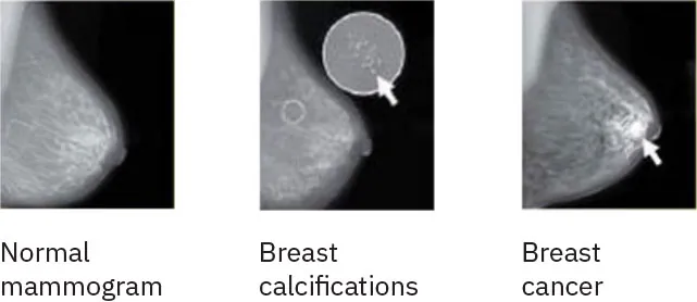 Three mammogram images of breasts show a normal mammogram result at the left, tiny white breast calcifications in the middle image, and breast cancer in the right image.