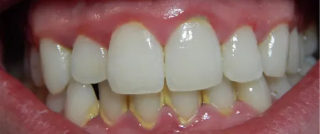 A photograph of teeth with gingivitis. It shows dark red at the gums around the lower teeth.