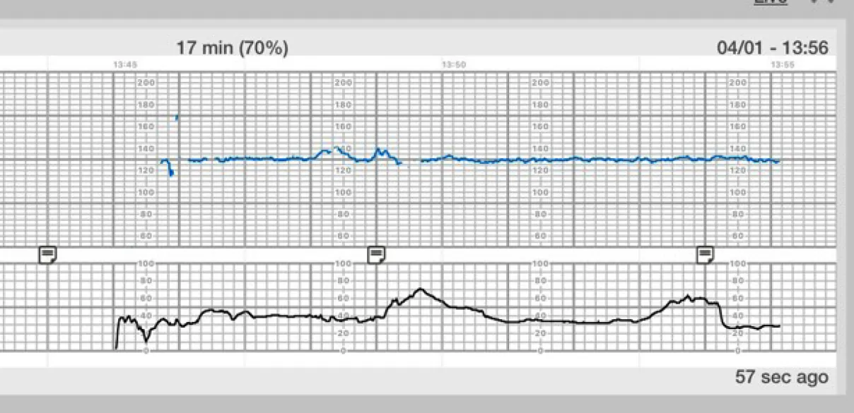 Fetal heart rate reading showing minimal variability.
