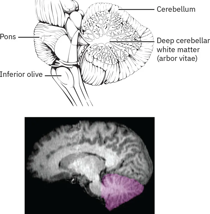 The image contains two diagrams of the human brain focusing on the cerebellum. The top diagram is a detailed anatomical drawing showing a section of the brain with key structures labeled: the cerebellum located at the lower back part of the brain, the deep cerebellar white matter (arbor vitae) inside the cerebellum, the pons positioned above the cerebellum as part of the brainstem, and the inferior olive near the base of the brainstem, adjacent to the cerebellum. The bottom diagram is a sagittal MRI scan of the brain, highlighting the cerebellum in purple to emphasize its location and structure within the brain, while the rest of the brain appears in grayscale, providing contrast to the highlighted cerebellum.
