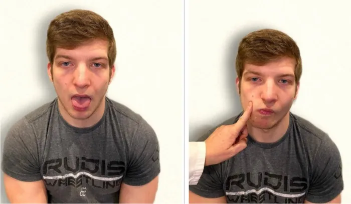 Photos showing assessment of Hypoglossal nerve on simulated patient