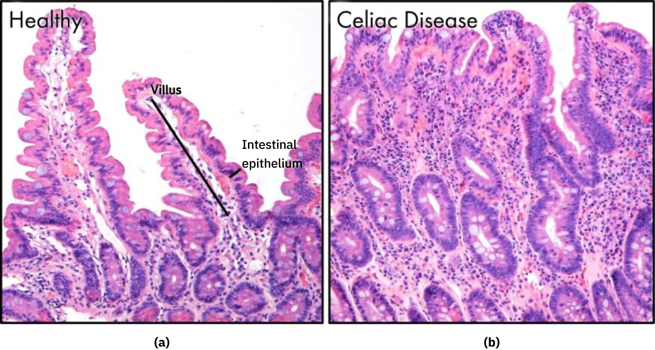 (a) Healthy intestine, labeling Villus and Intestinal epithelium. (b) Intestine showing celiac disease.