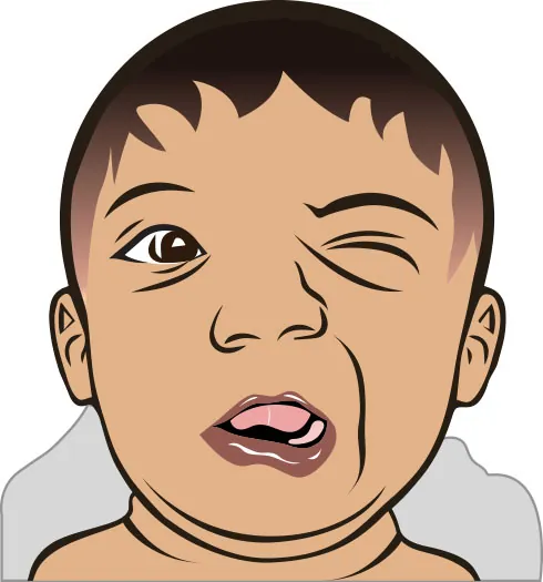 An illustration of a baby's face with asymmetrical expression, indicating facial paralysis on one side.