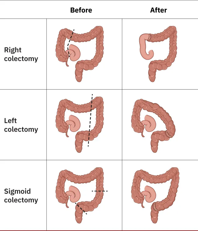 Illustration showing Before and After for three common types of surgical resection to treat colorectal cancer: Right colectomy, Left colectomy, and Sigmoid colectomy.