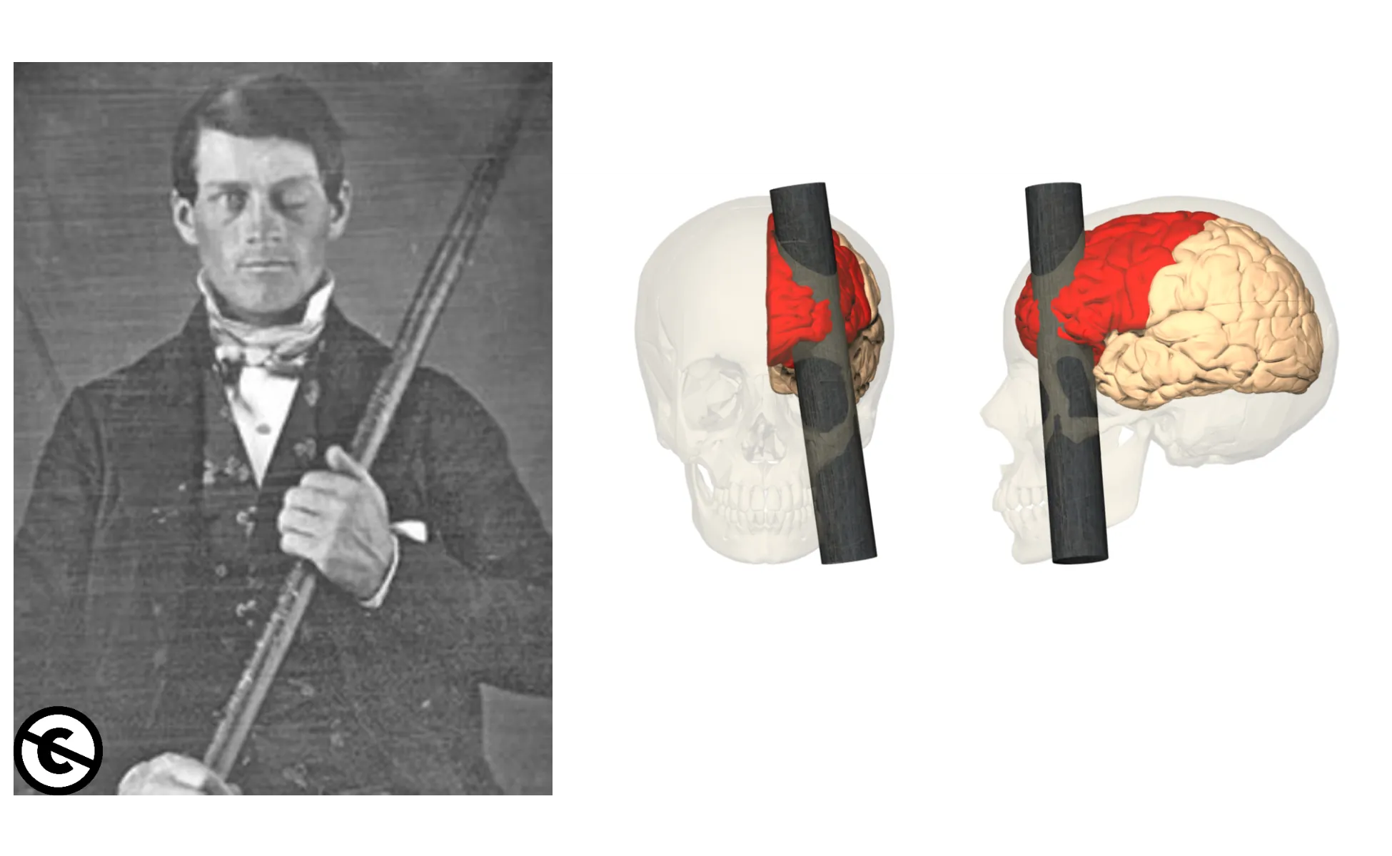 Photo of Phineas Gage holding a rod and a modern reconstruction of the brain damage that he suffered, with the rod penetrating prefrontal cortex.